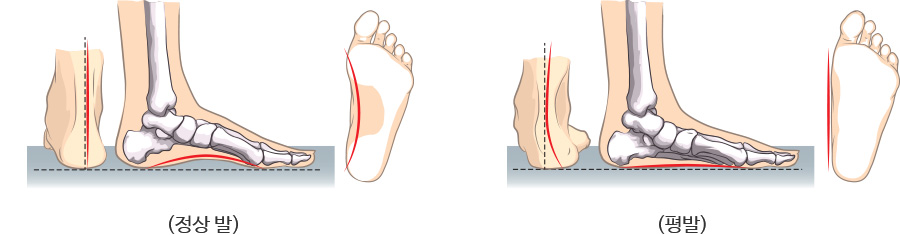 정상발과 평발비교