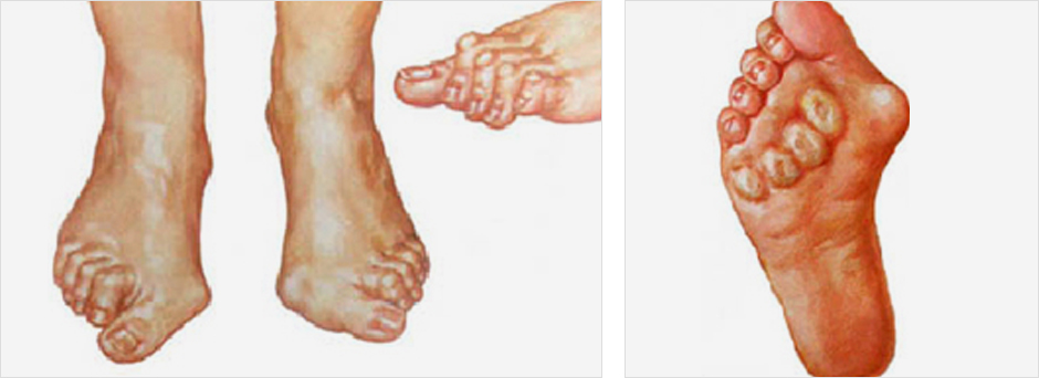 류마티스 이미지