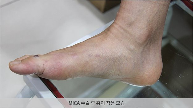 MICA 수술 후 흉이 작은 모습